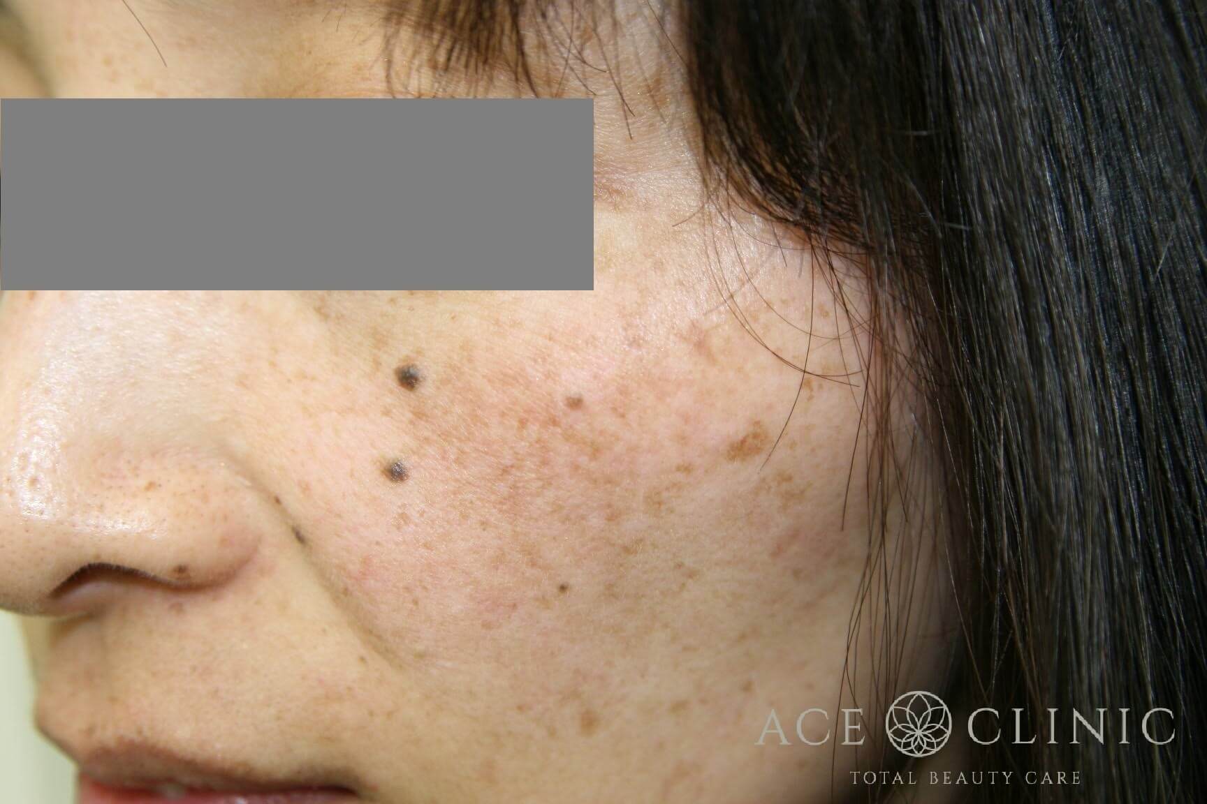 レーザーフェイシャル+ピコレーザートーニング 施術前 左斜め