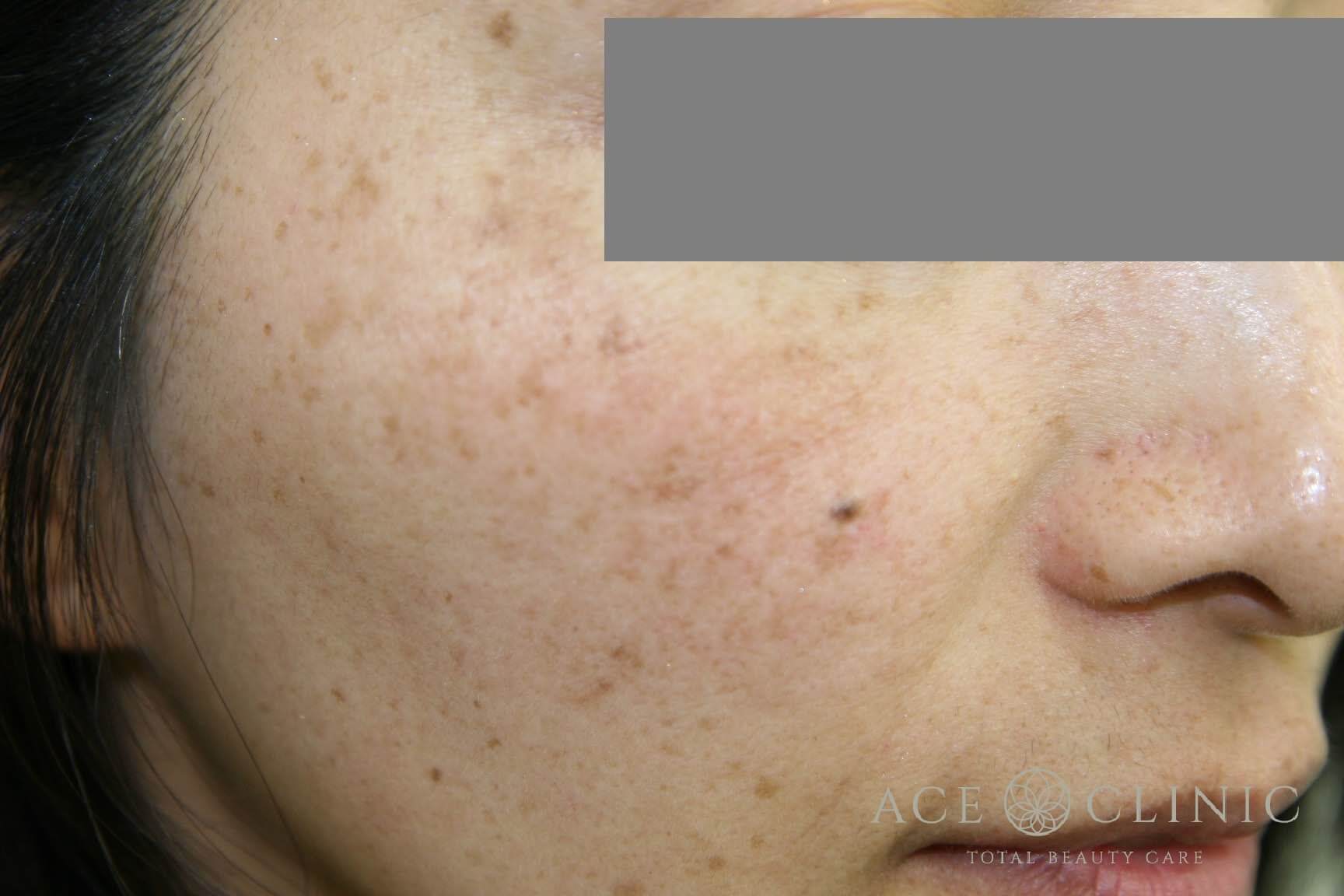 レーザーフェイシャル+ピコレーザートーニング 施術前 右斜め