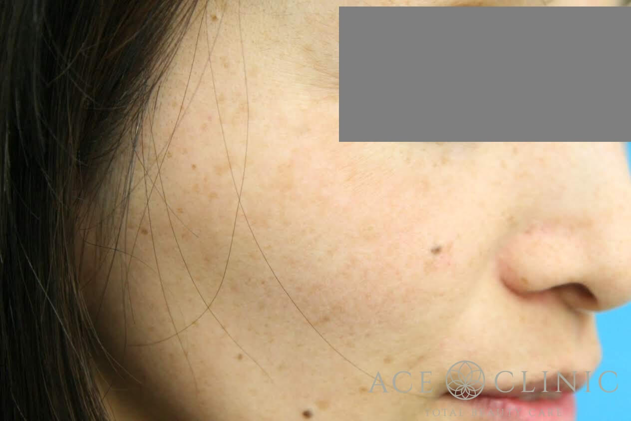 レーザーフェイシャル+ピコレーザートーニング 施術後 右斜め