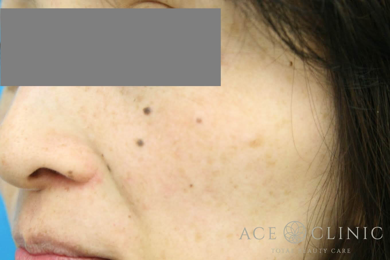 レーザーフェイシャル+ピコレーザートーニング 施術後 左斜め