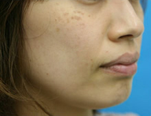 シミ　レーザー治療　右斜め　施術前｜ADM（後天性真皮メラノサイトーシス）｜【エースクリニック】大阪梅田院