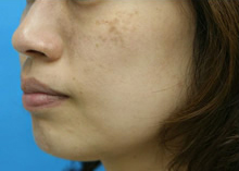 シミ　レーザー治療　左斜め　施術前｜ADM（後天性真皮メラノサイトーシス）｜【エースクリニック】大阪梅田院