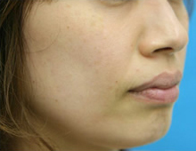 シミ　レーザー治療　右斜め　施術後｜ADM（後天性真皮メラノサイトーシス）｜【エースクリニック】大阪梅田院