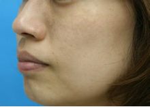 シミ　レーザー治療　左斜め　施術後｜ADM（後天性真皮メラノサイトーシス）｜【エースクリニック】大阪梅田院