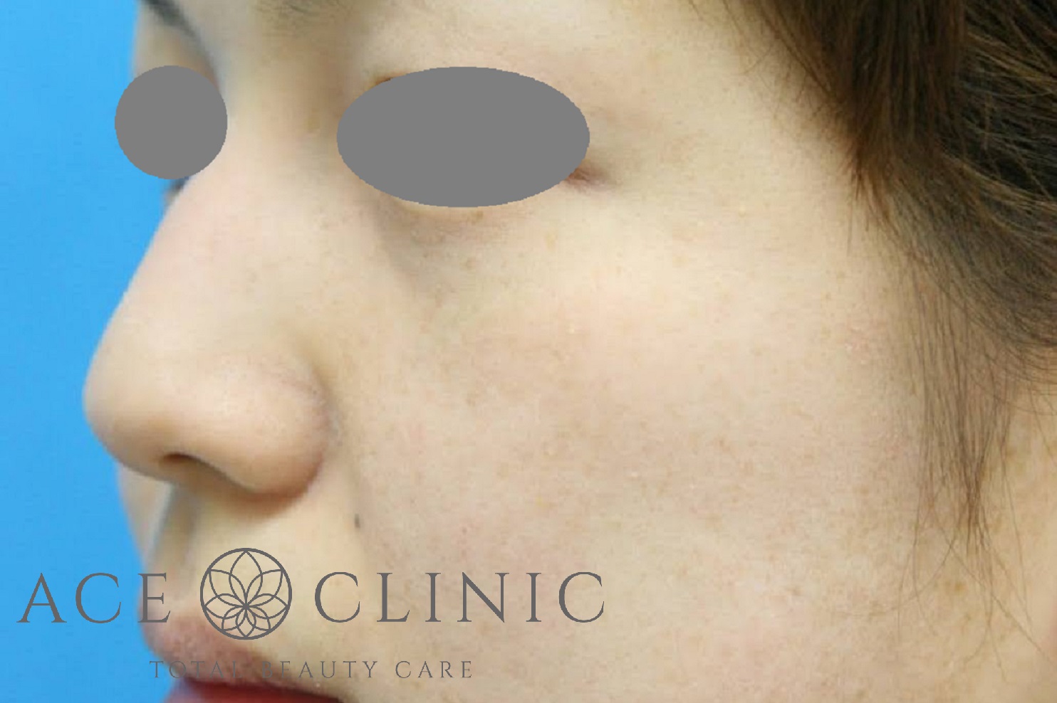 シミ　レーザー治療　左斜め　施術後｜雀卵斑（そばかす）｜【エースクリニック】大阪梅田院