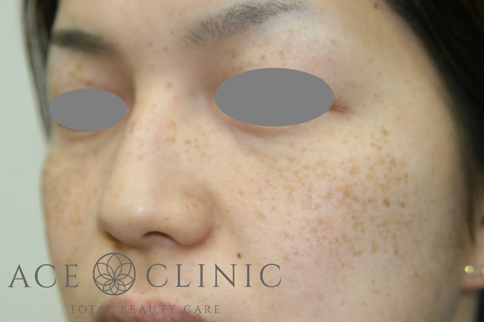 シミ　レーザー治療　左斜め　施術前｜雀卵斑（そばかす）｜【エースクリニック】大阪梅田院