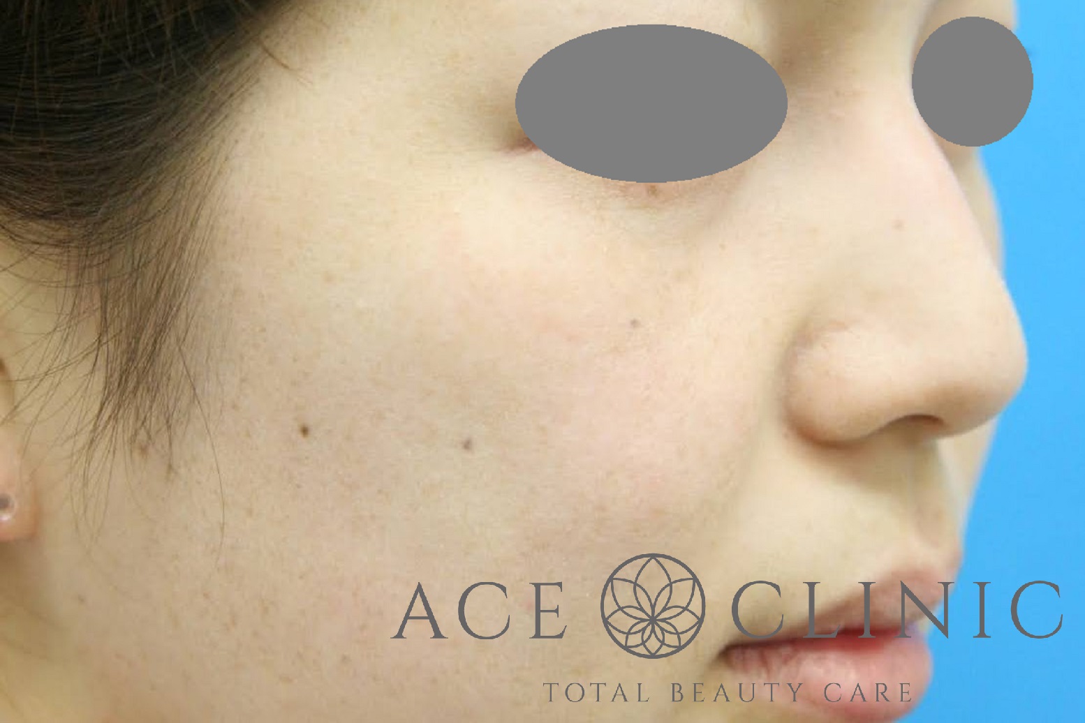 シミ　レーザー治療　右斜め　施術後｜雀卵斑（そばかす）｜【エースクリニック】大阪梅田院