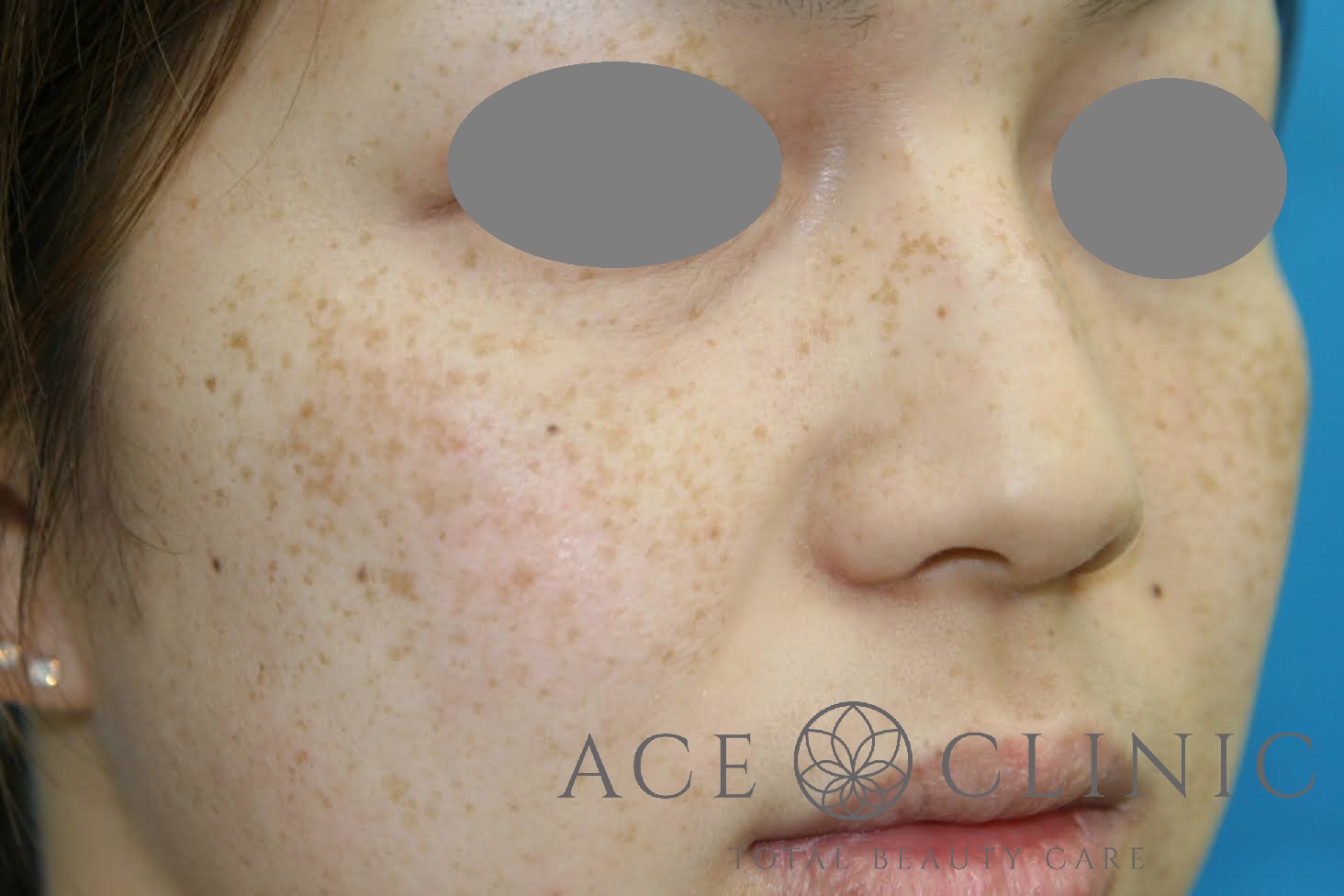 シミ　レーザー治療　右斜め　施術前｜雀卵斑（そばかす）｜【エースクリニック】大阪梅田院