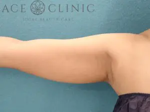 Postoperative-course-of-upper-arm-liposuction-before-300x225