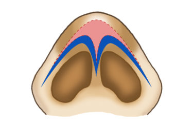 大鼻翼軟骨上の脂肪組織の切除