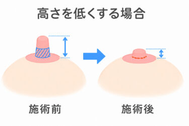 乳頭縮小術の高さを低くする場合