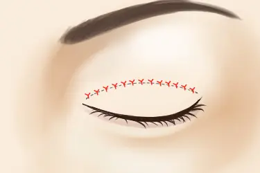 suture-double-eyelid-incision-method