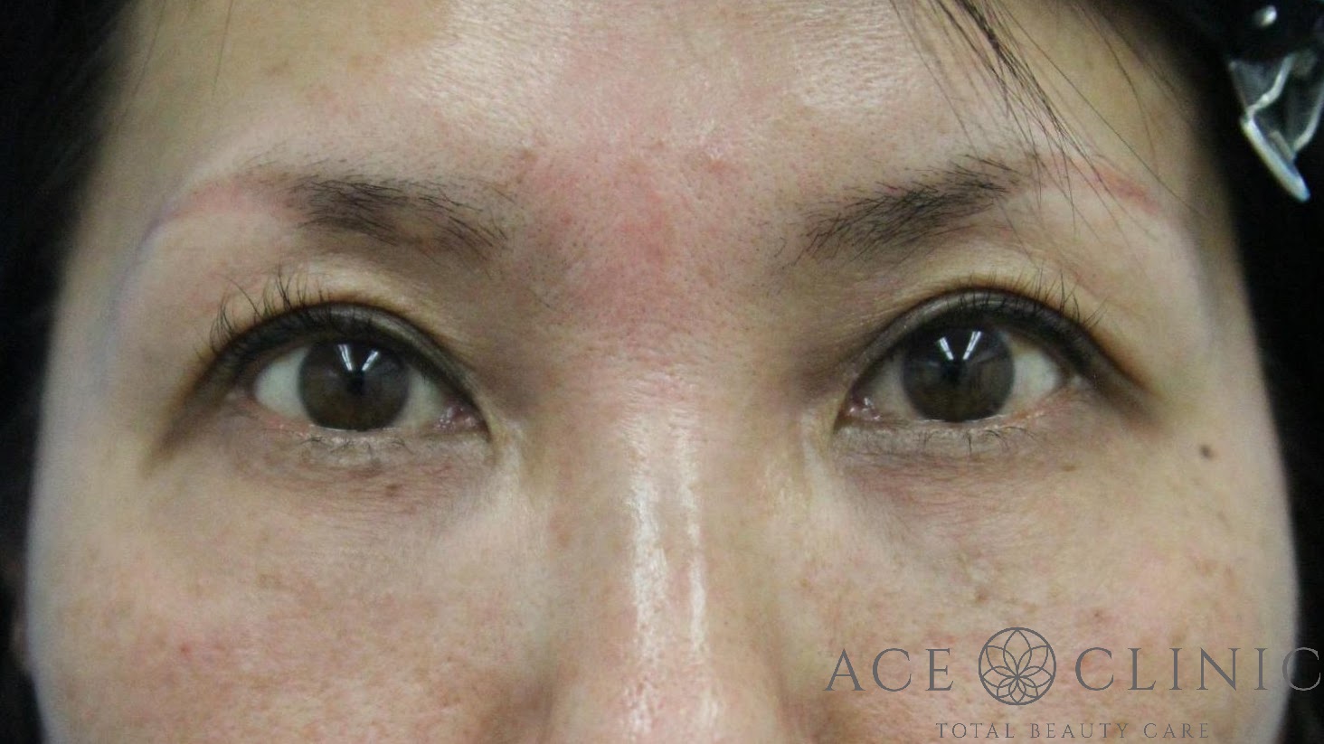 切らないクマ治療　ヒアルロン酸注射+HIFU　40代女性　施術後　【エースクリニック】名古屋院・大阪梅田院