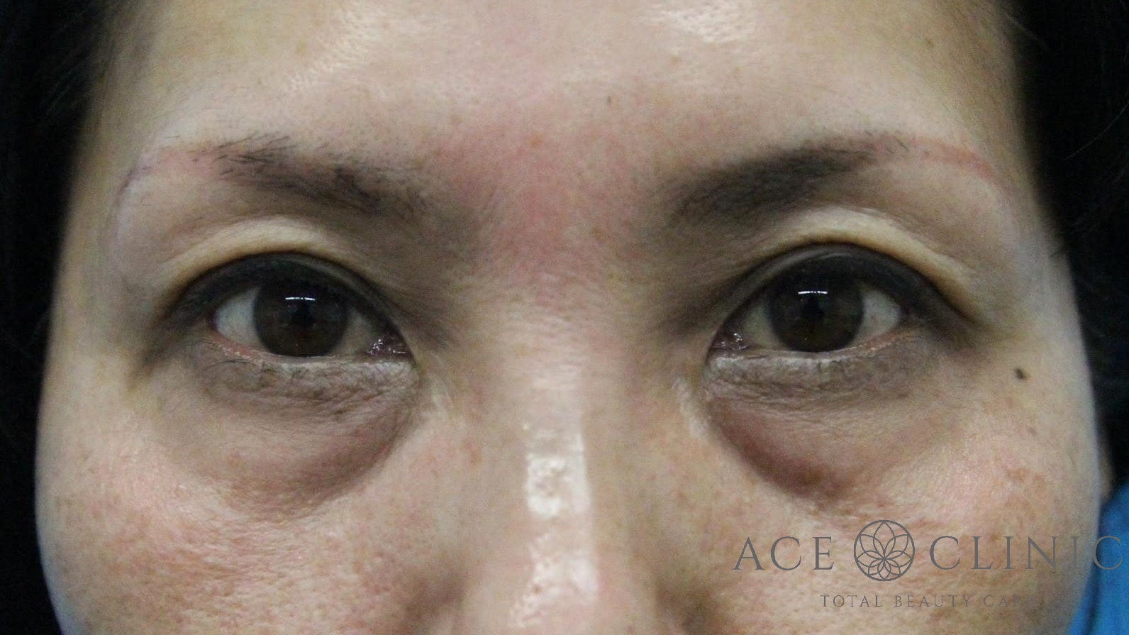 切らないクマ治療　ヒアルロン酸注射+HIFU　40代女性　施術前　【エースクリニック】名古屋院・大阪梅田院