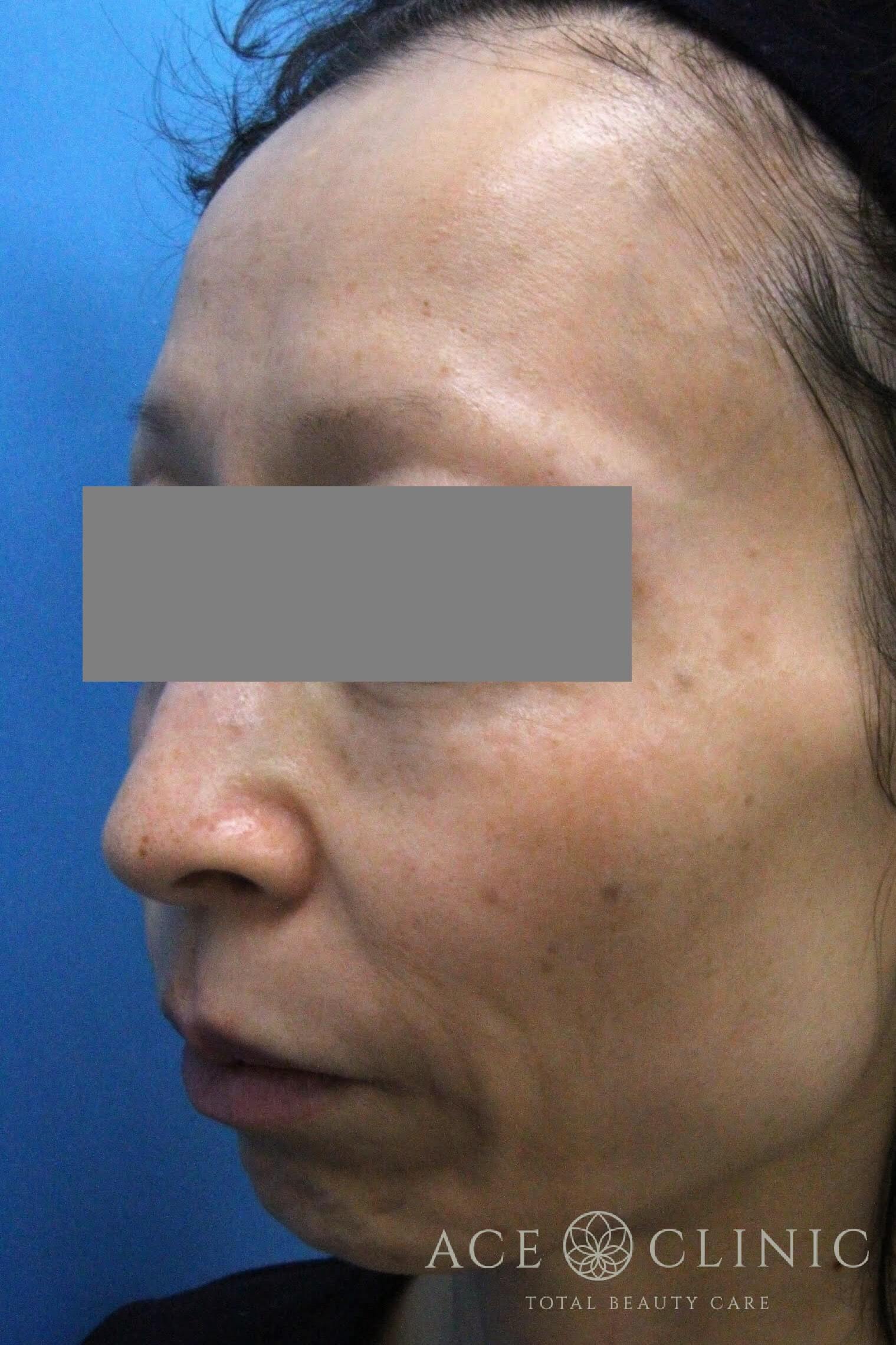 ウルセラ　施術前　左斜め