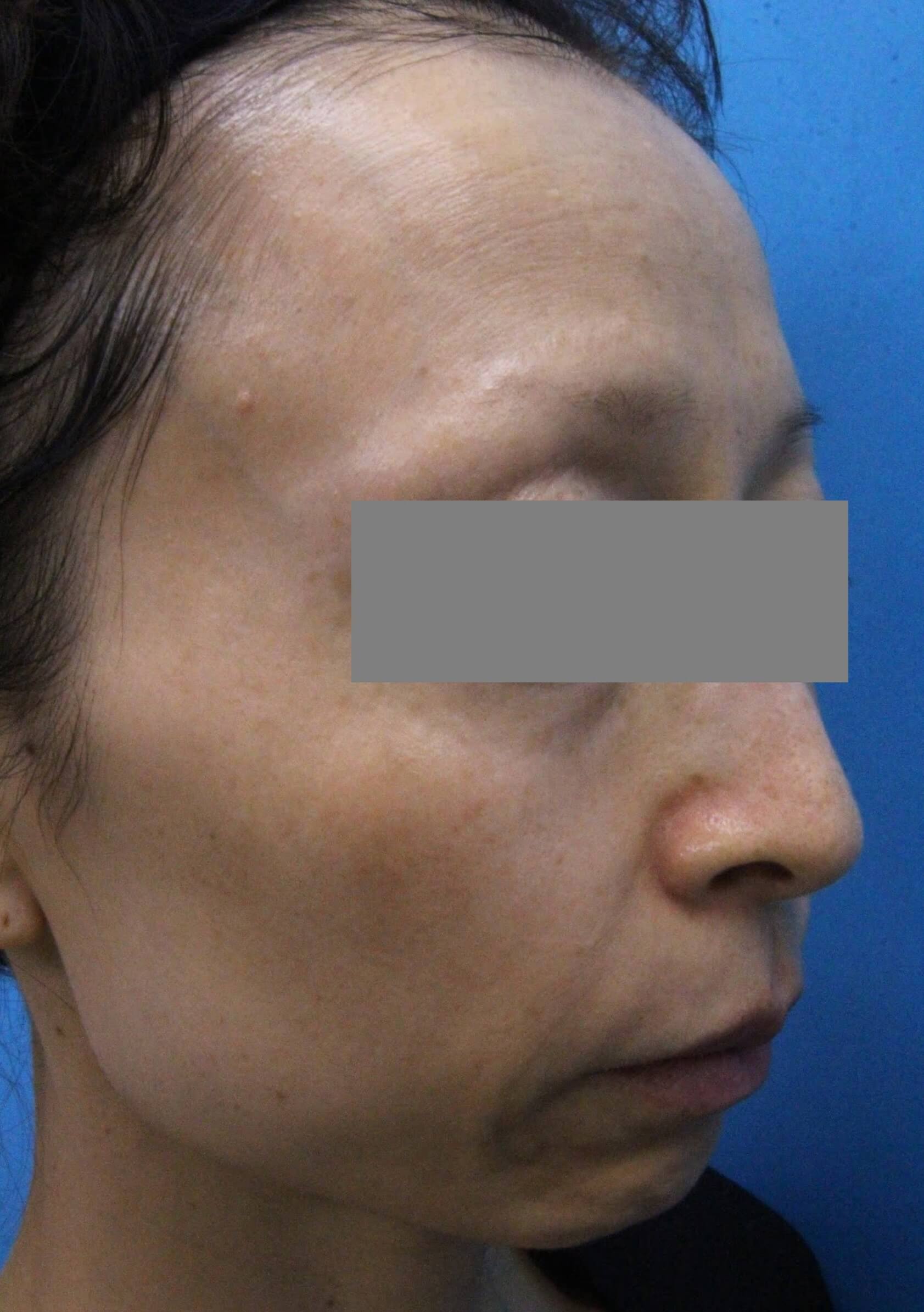 ウルセラ　施術前　右斜め