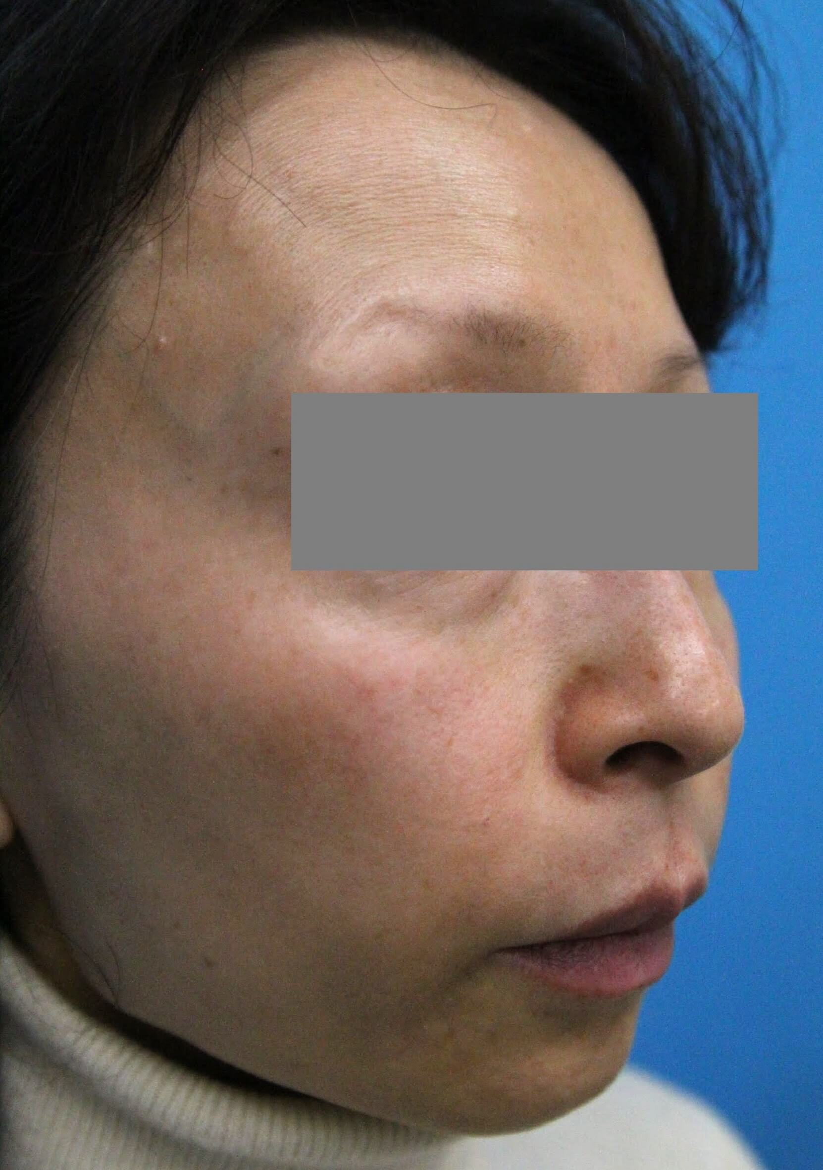 ウルセラ　施術後　右斜め