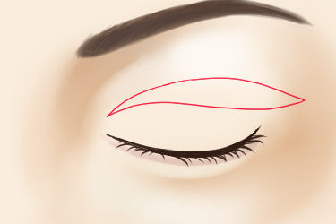 重瞼線皮膚切除法のデザイン