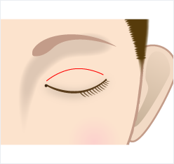眼瞼挙筋前転法のデザイン