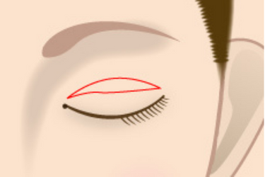重瞼線皮膚切除法