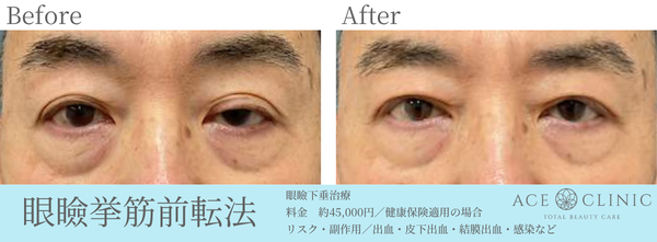 眼瞼下垂症例