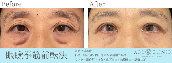 眼瞼下垂症例