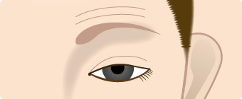 先天性眼瞼下垂症のイメージ