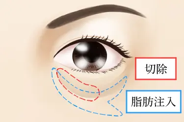 lower-eyelid-fat-removal-and-CRF-injection