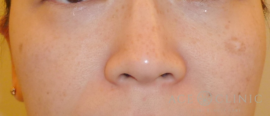 老人性色素斑　ピコレーザー照射前