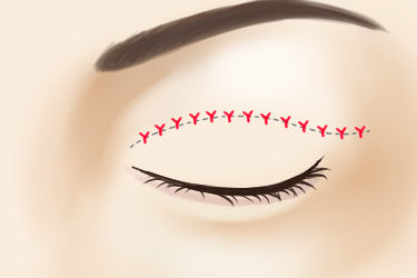 重瞼線皮膚切除法の皮膚縫合