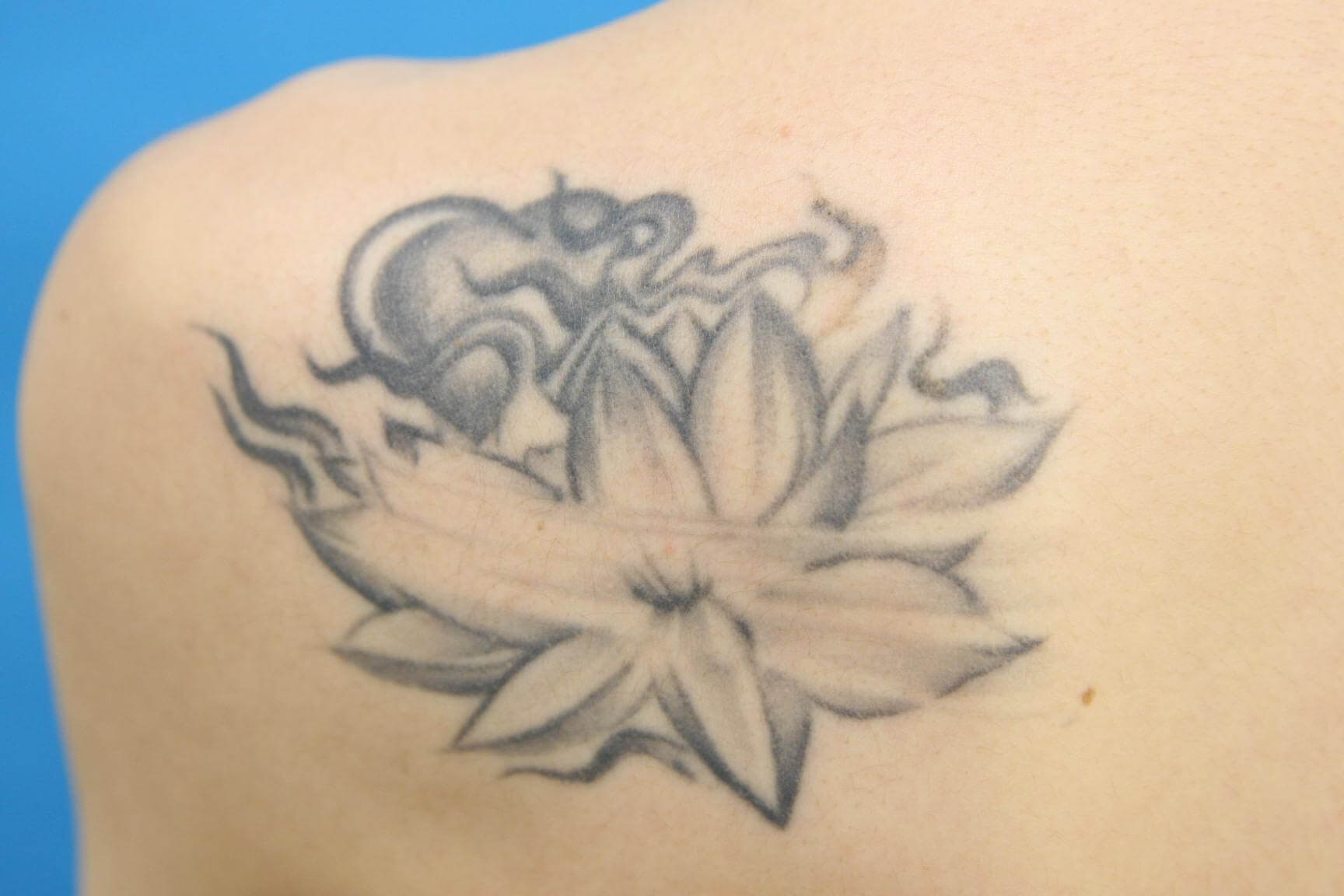 左肩のタトゥー レーザー除去 治療前