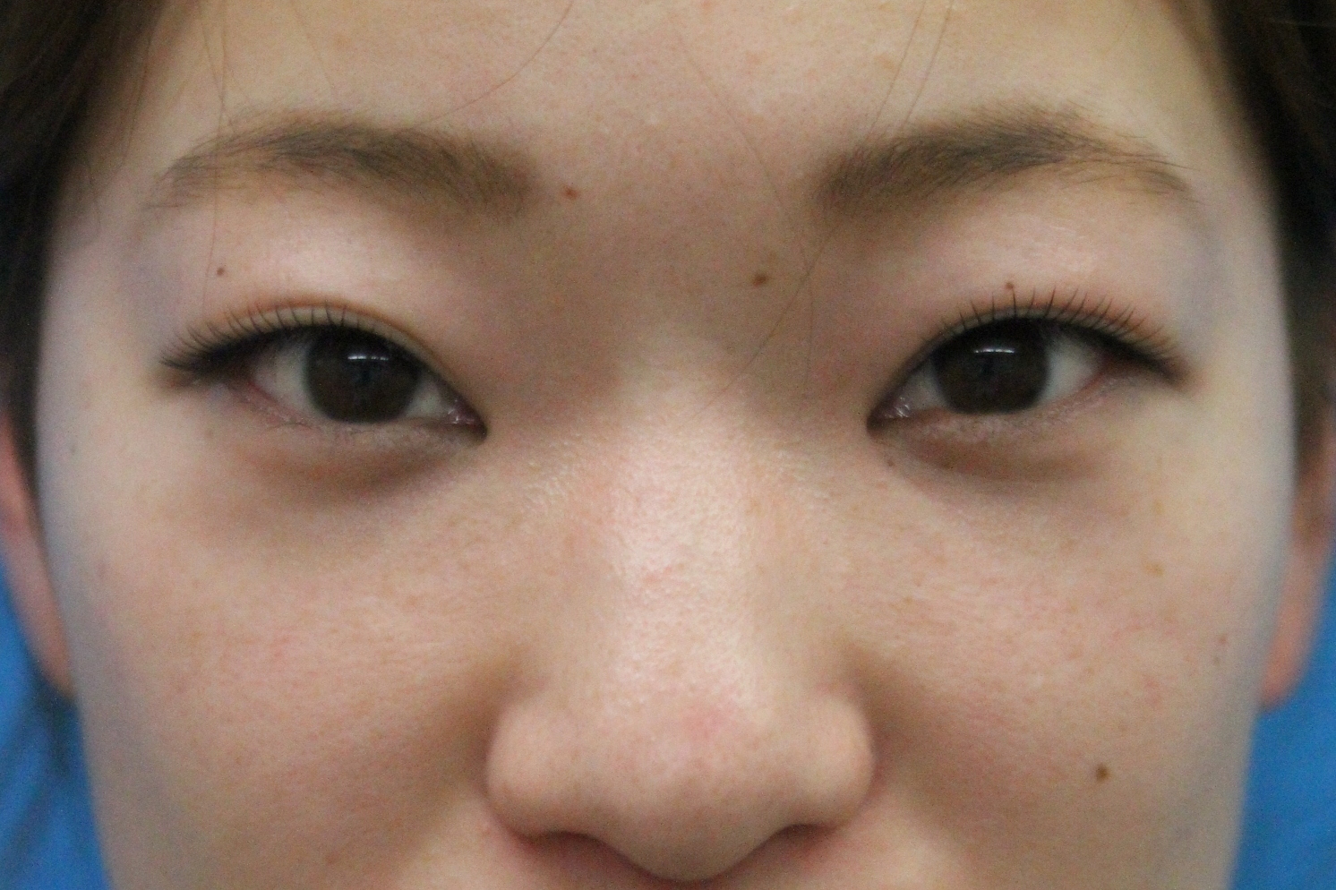 クマ治療_経結膜ハムラ法【エースクリニック】名古屋院・大阪梅田院