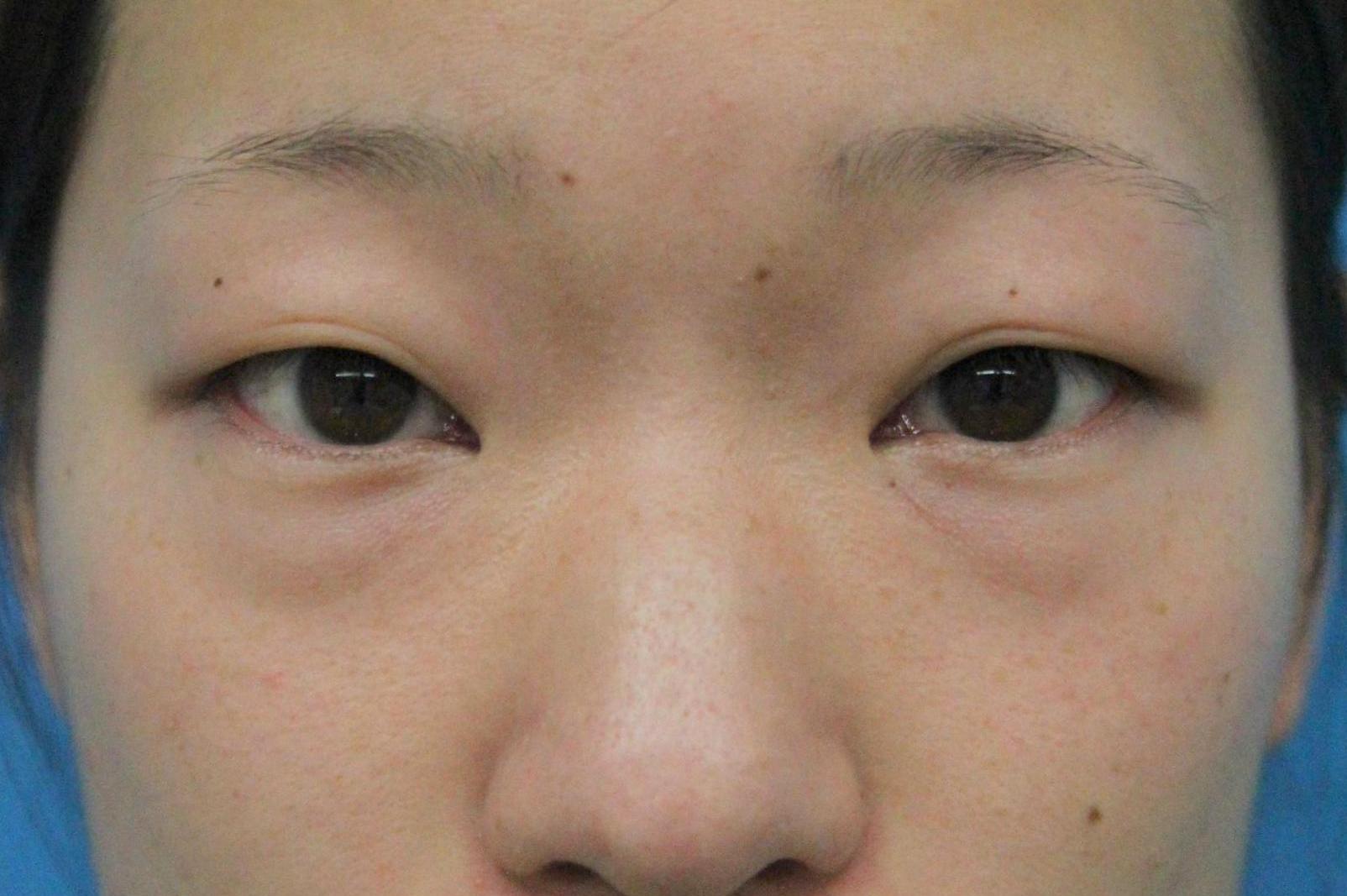 クマ治療_経結膜ハムラ法【エースクリニック】名古屋院・大阪梅田院