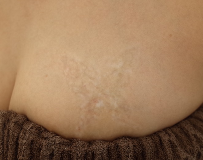 大阪梅田院_タトゥーレーザー除去症例_エースクリニック