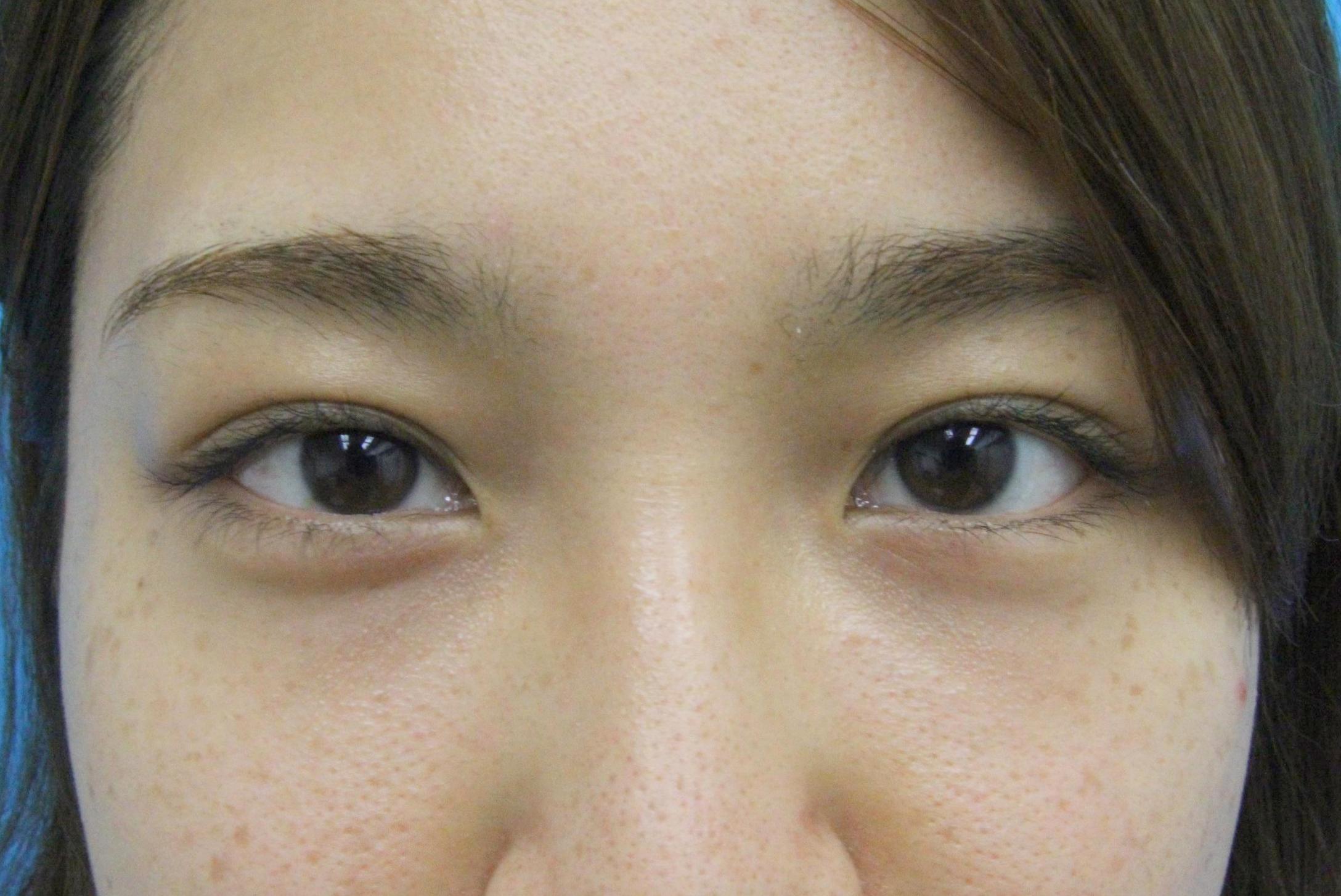 クマ治療_経結膜ハムラ法【エースクリニック】名古屋院・大阪梅田院