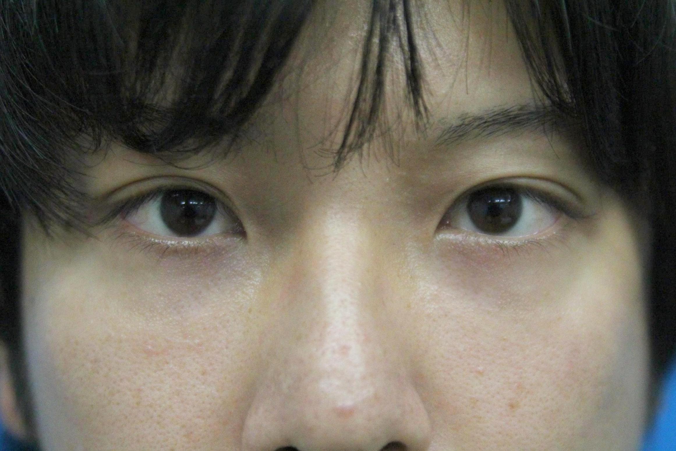 クマ治療_経結膜ハムラ法【エースクリニック】名古屋院・大阪梅田院