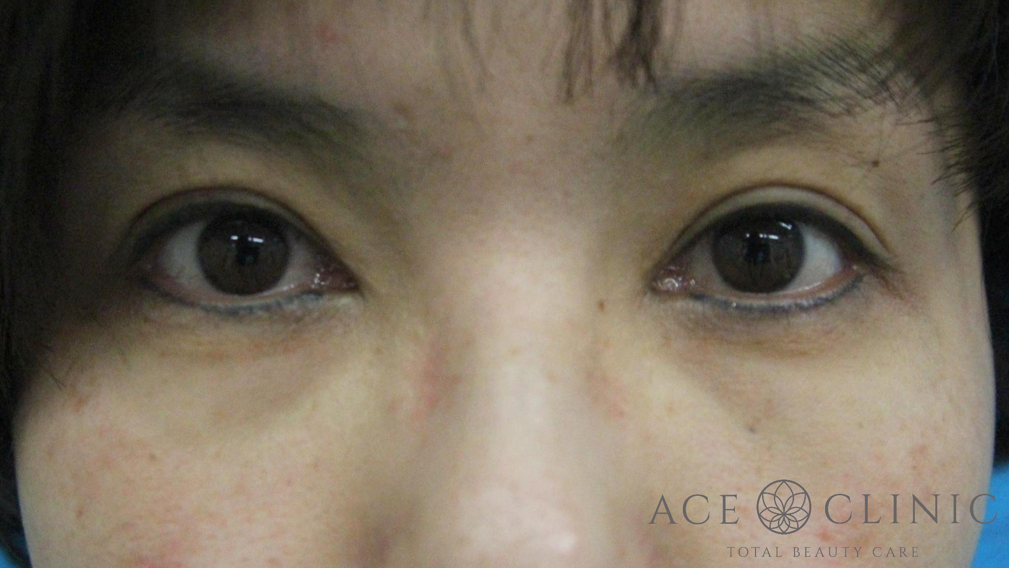 切らないクマ治療　HIFU+ヒアルロン酸注入　40代女性　施術前　【エースクリニック】名古屋院・大阪梅田院