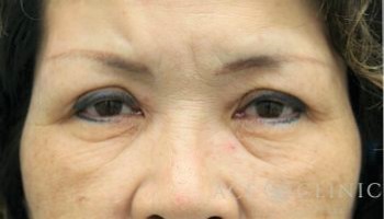 皮切ハムラ法_【エースクリニック】名古屋・大阪梅田_クマ治療