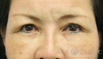 皮切ハムラ法_【エースクリニック】名古屋・大阪梅田_クマ治療