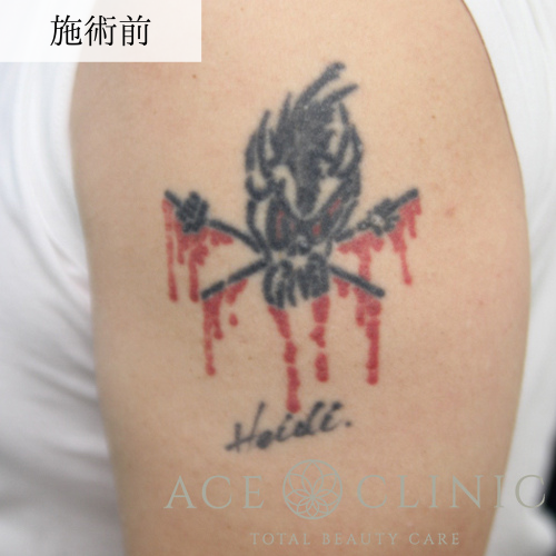 大阪梅田院_タトゥー除去レーザー症例【エースクリニック】