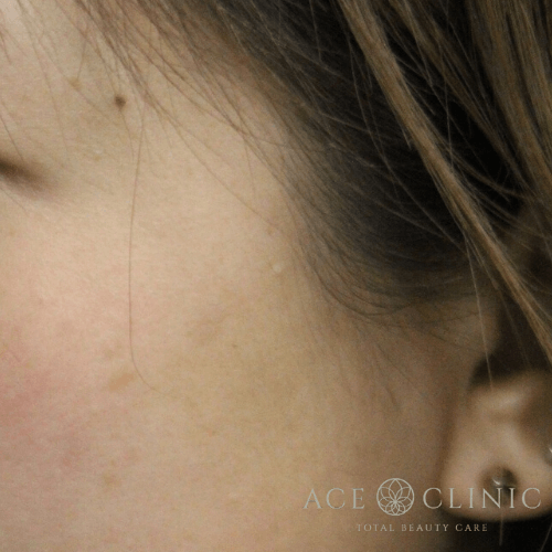 左頬　老人性色素斑　レーザー照射後1ヶ月