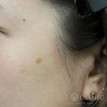 左頬　老人性色素斑　レーザー照射前