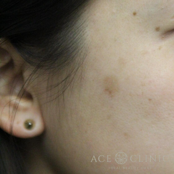 右頬　老人性色素斑　レーザー照射前