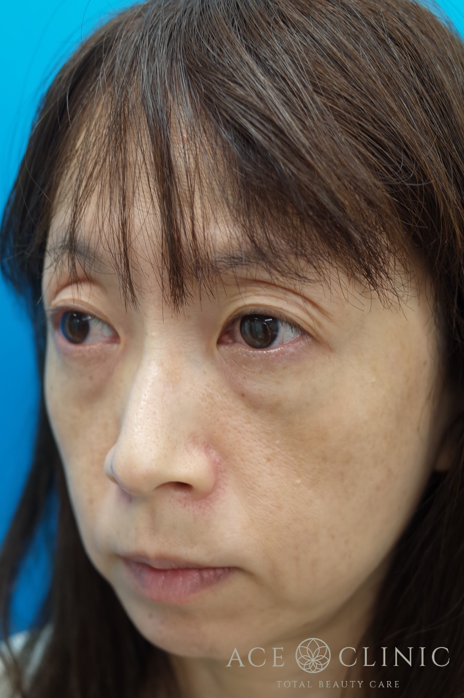 ヒアルロン酸リフト 施術前 左斜め