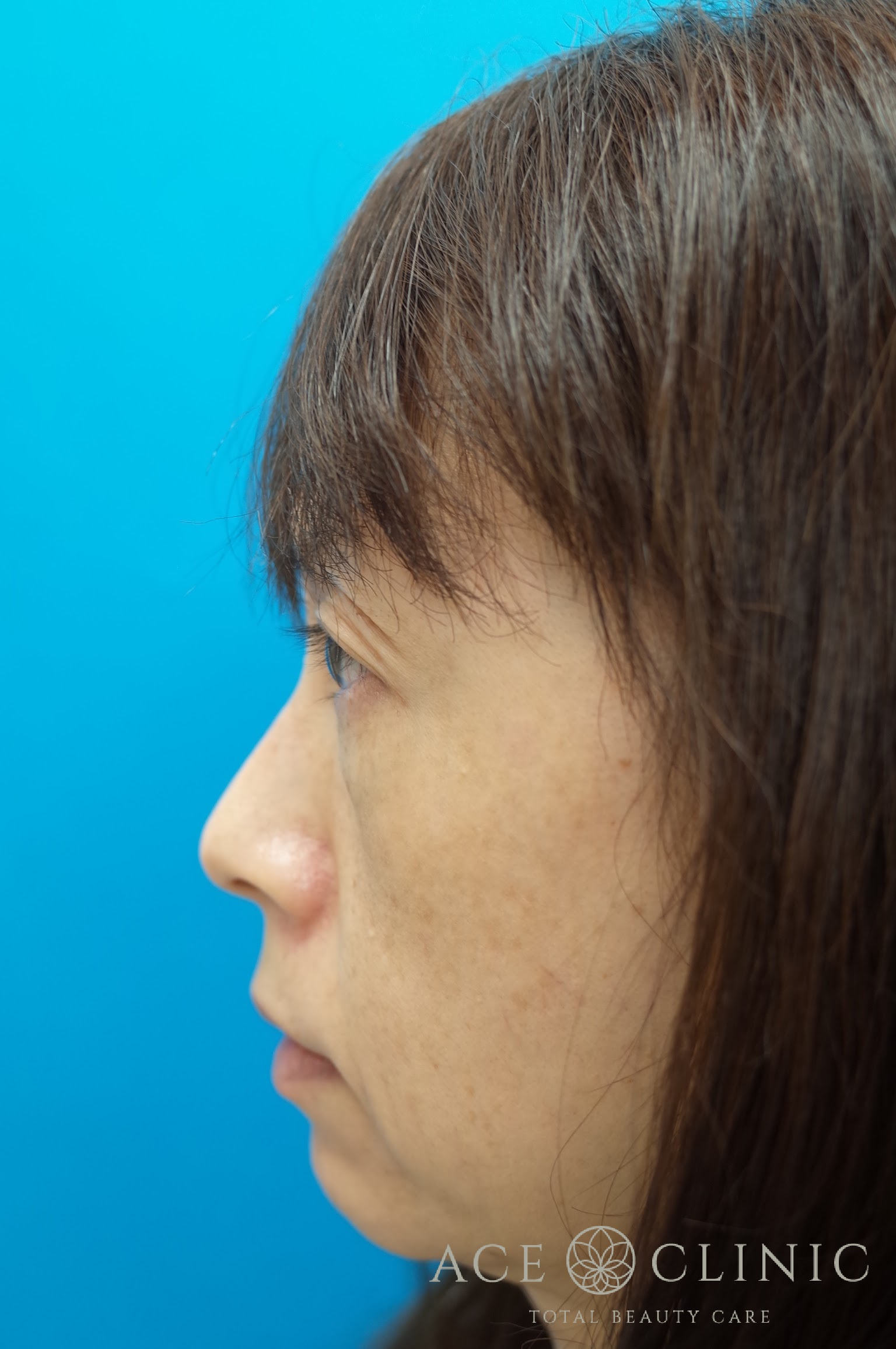 ヒアルロン酸リフト 施術前 左横