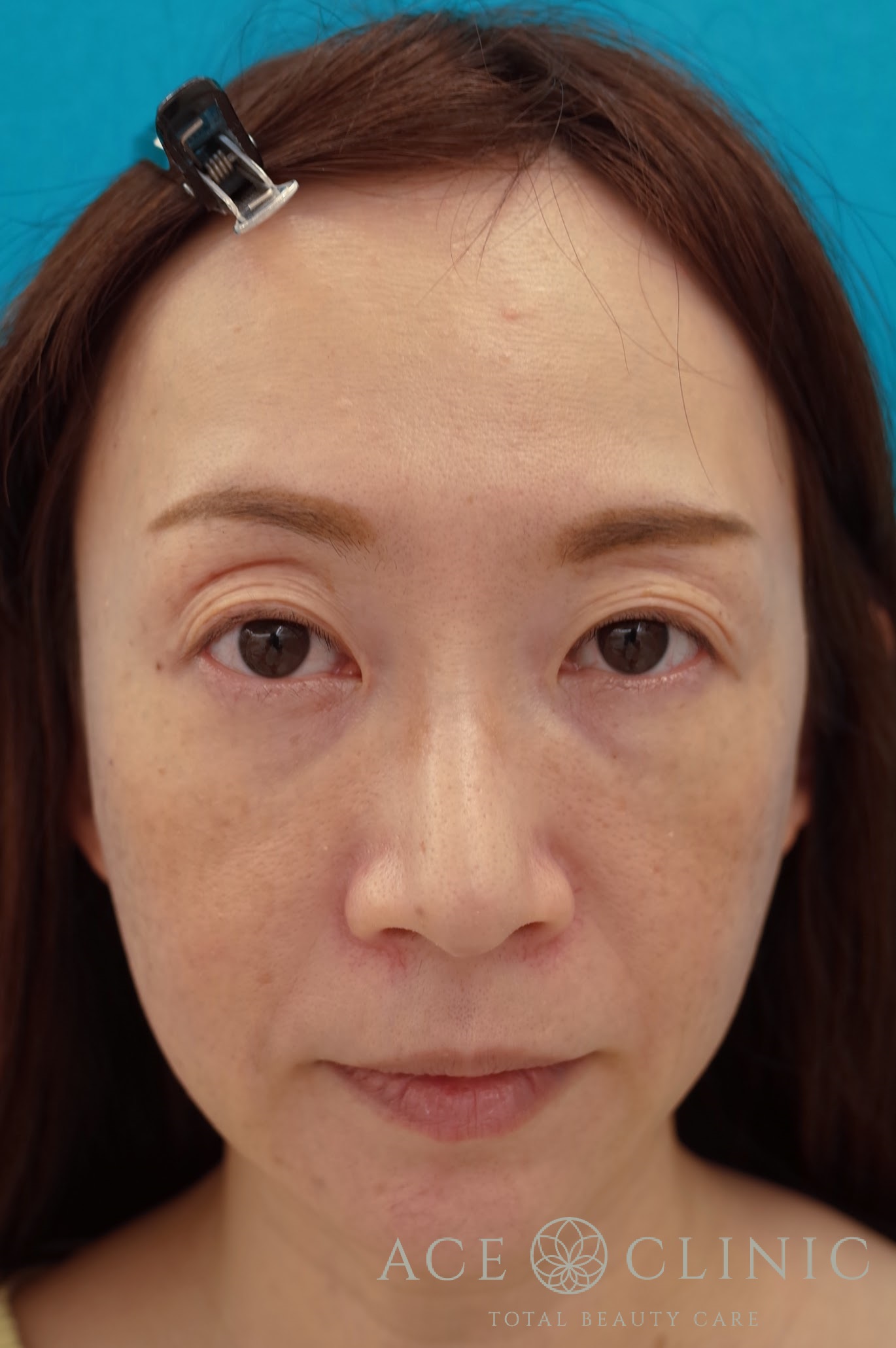 ヒアルロン酸リフト　施術後　正面