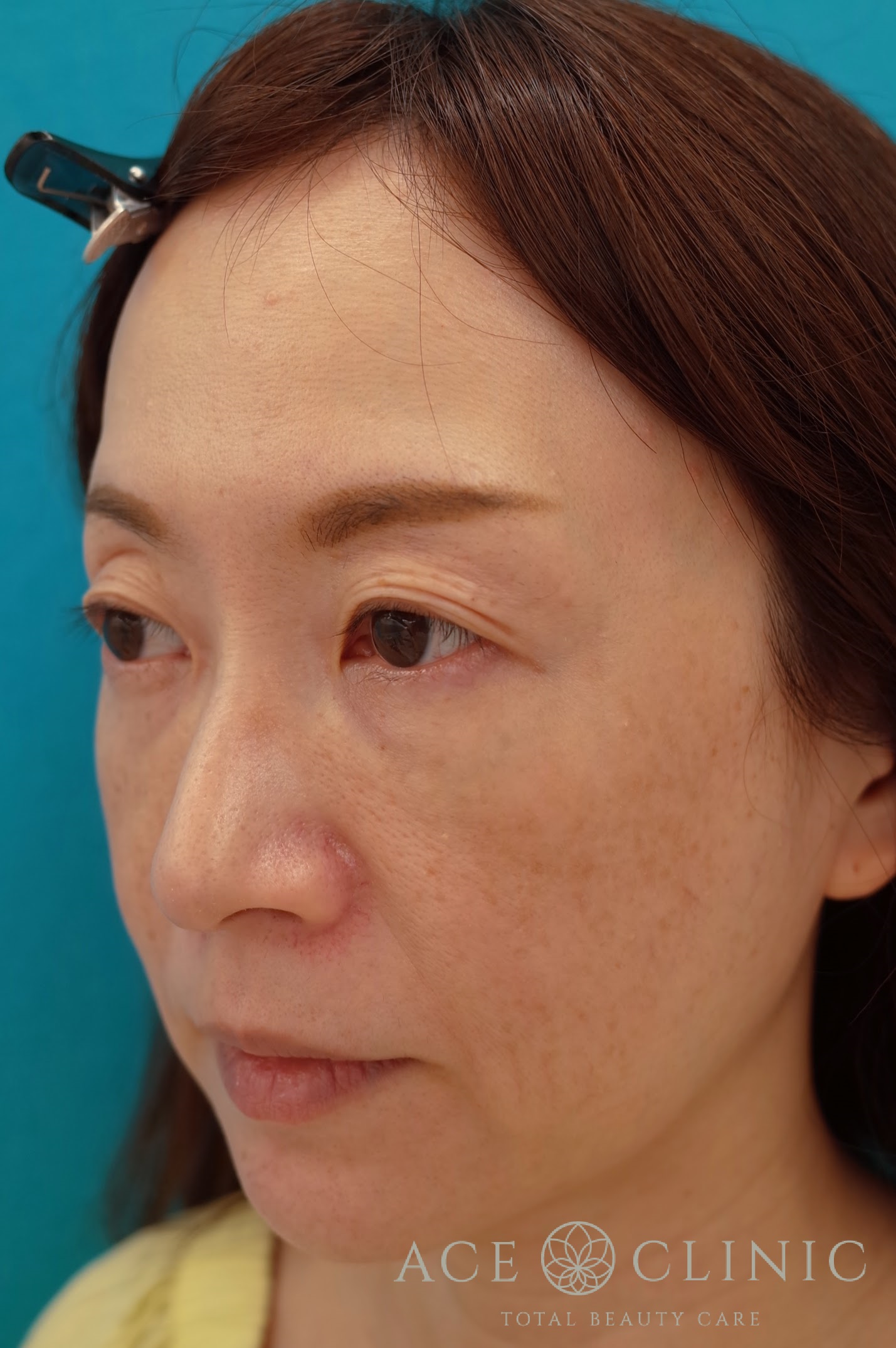 ヒアルロン酸リフト 施術後 左斜め