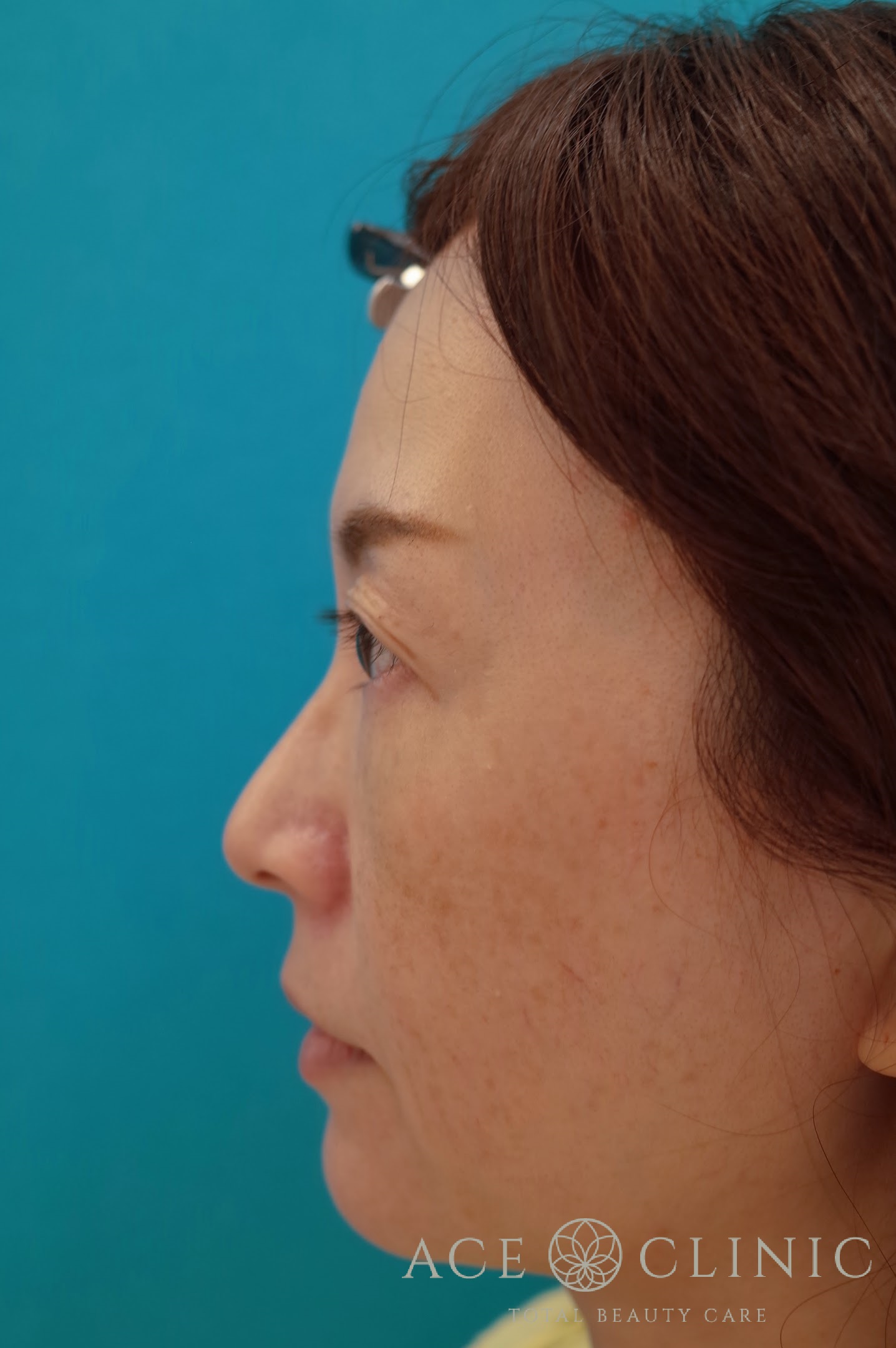 ヒアルロン酸リフト 施術後 左横