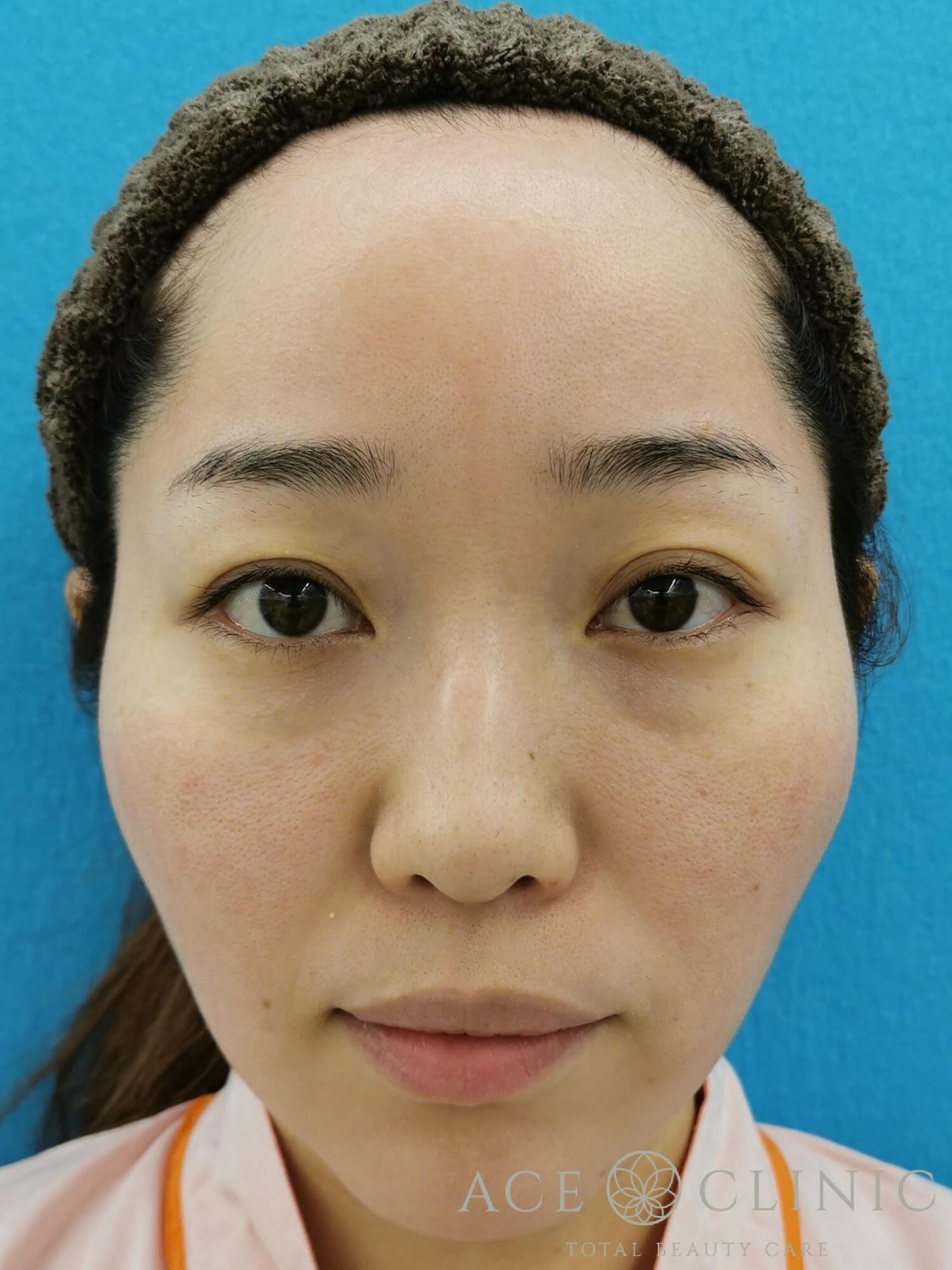 ヒアルロン酸注入(鼻・ほうれい線) 施術前 正面