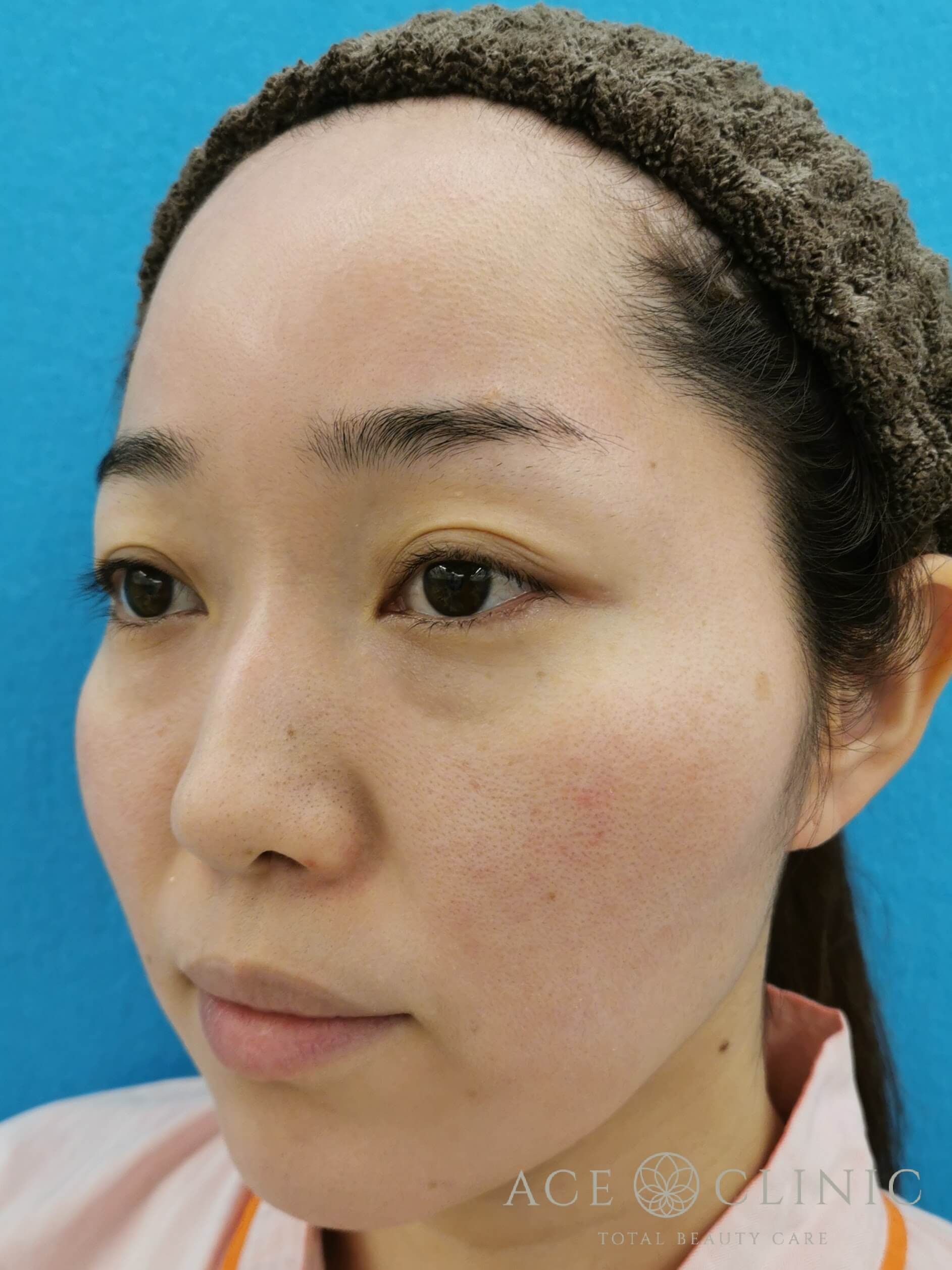 ヒアルロン酸注入（鼻・ほうれい線）　施術前　斜め